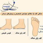 صافی کف پا: علائم، عوارض، تشخیص و بهترین روش‌های درمان