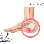 خار پاشنه چیست؟ علائم، علت و درمان بدون جراحی