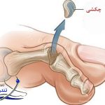 درمان انگشت چکشی بدون جراحی با کفش، کفی و تمرین – کلینیک تندرست تهران