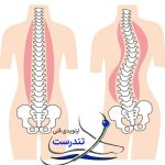 اسکولیوز (انحراف ستون فقرات) چیست؟ علائم، عوارض و درمان‌های موثر در کلینیک تندرست