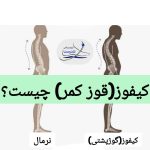 کیفوز یا گوژپشتی چیست؟ – علل علائم و روش های درمان کیفوز