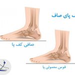 آیا کف پای صاف درمان می ‎شود؟
