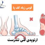 گودی و قوس زیاد کف پا (پس کاووس)؛ علل، علائم و درمان + عوارض