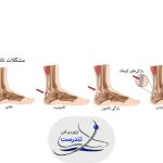 کوتاهی تاندون آشیل (کوتاهی آشیل پا) درمان و علت