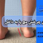 چرخش مچ پا به داخل در کودکان