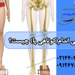 درمان کوتاهی پا: رفع اختلاف طول پا بدون جراحی