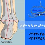 چرخش مچ پا به خارج در کودکان ؛ از علت تا درمان