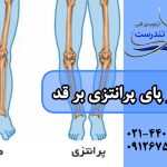 تاثیر پای پرانتزی بر قد