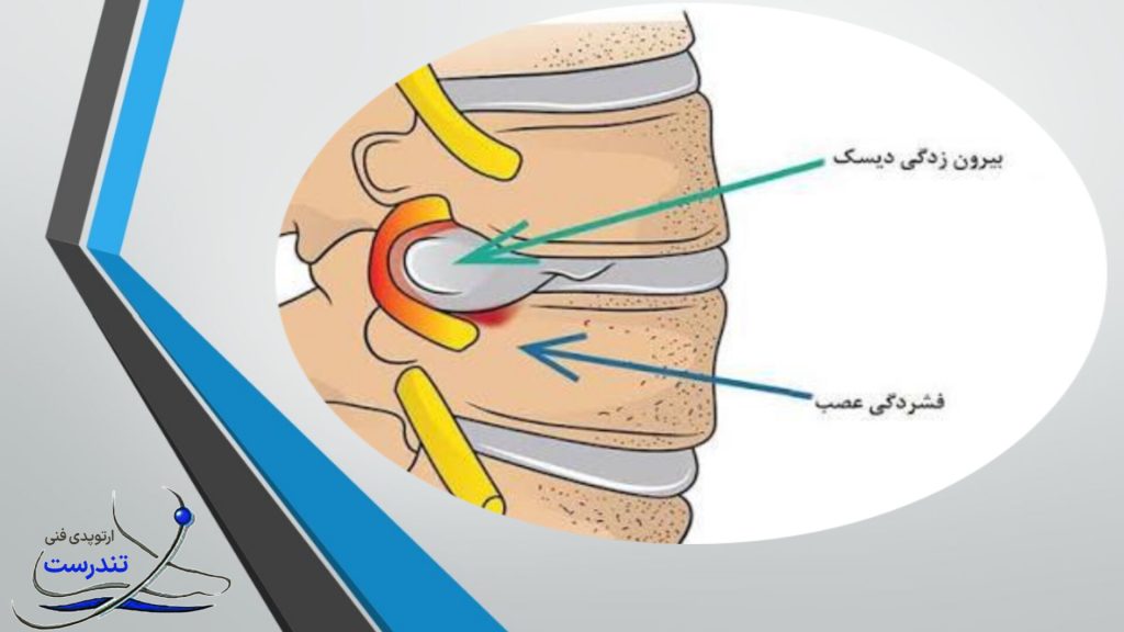 دیسک کمر درمان دیسک کمر 